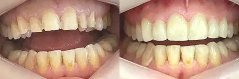 Caso de carillas dentales en 2 sesiones, antes y después – consultorio de Funes