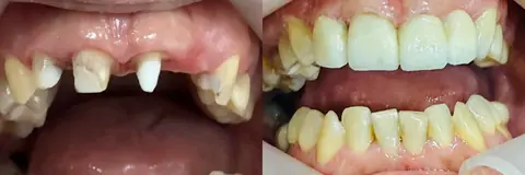 Caso de coronas sin metal y sin implantes, antes y después – consultorio de Funes