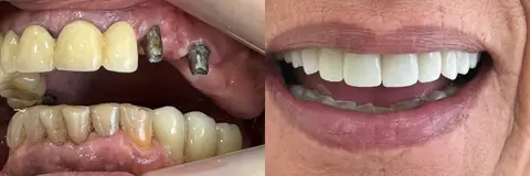 Caso de rehabilitación integral con implantes sin metal, antes y después – consultorio de Funes