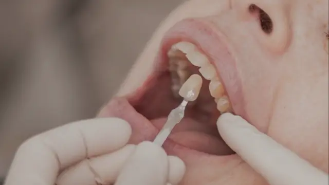 Selección del color dental para un tratamiento de estética en Funes